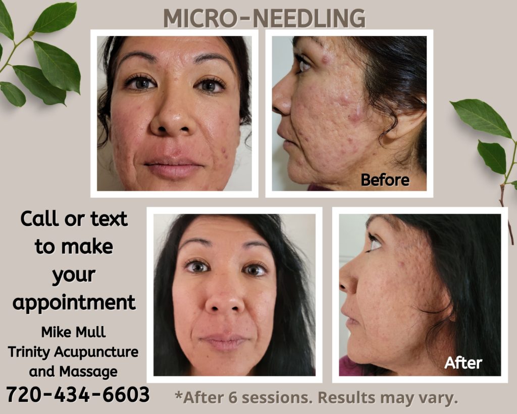 Micro-needling Before and After Collage